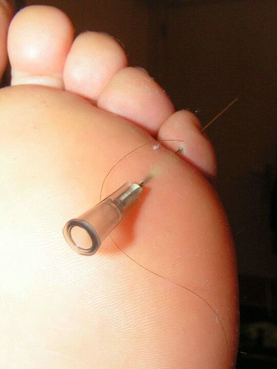 12P Restrained white girl has needles inserted into various body parts