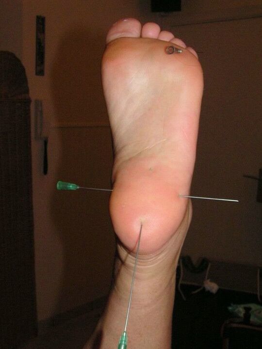 12P Restrained white girl has needles inserted into various body parts