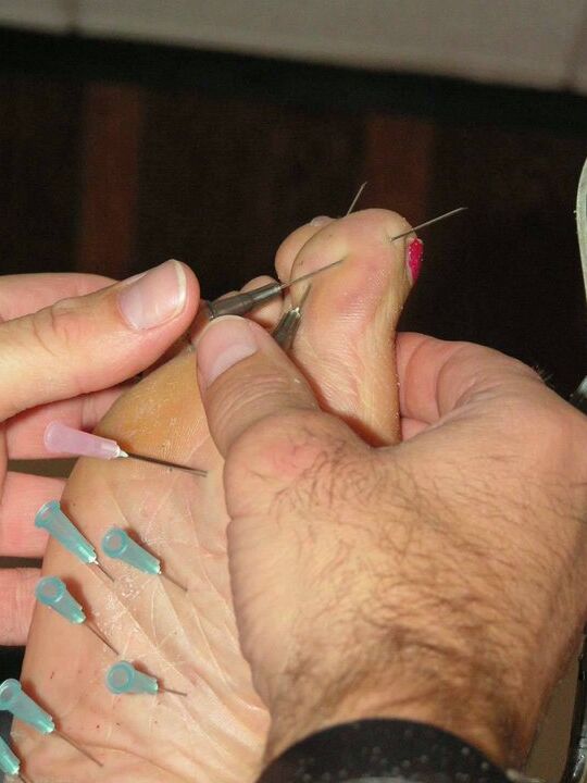 12P Restrained female has needles inserted into her bare feet