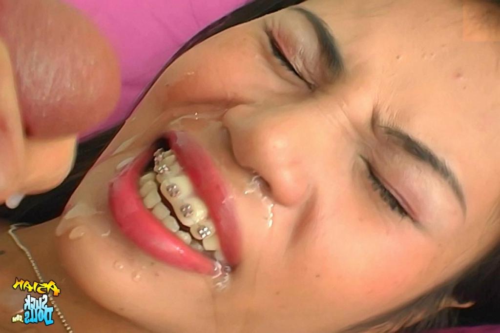 15P Das asiatische Mädchen Nue lässt sich in einer Nahaufnahme auf ihre Zahnspange spritzen